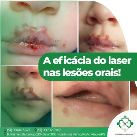 A eficácia do laser nas lesões orais!