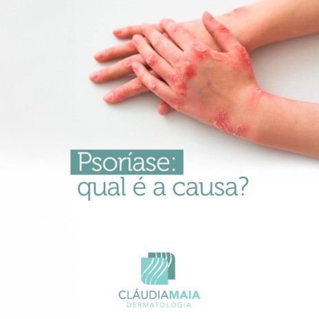 Psoríase: qual é a causa?