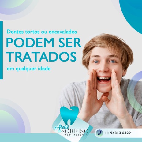 Dentes tortos ou encavalados podem ser tratados em qualquer idade