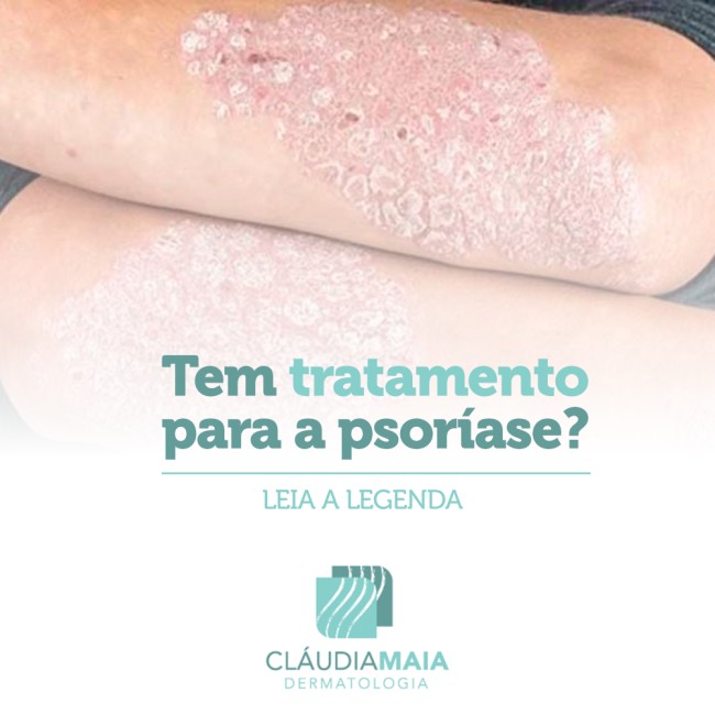 Tem tratamento para a psoríase?
