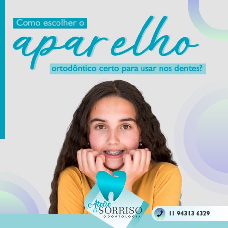 Como escolher o aparelho ortodôntico certo para usar nos dentes?