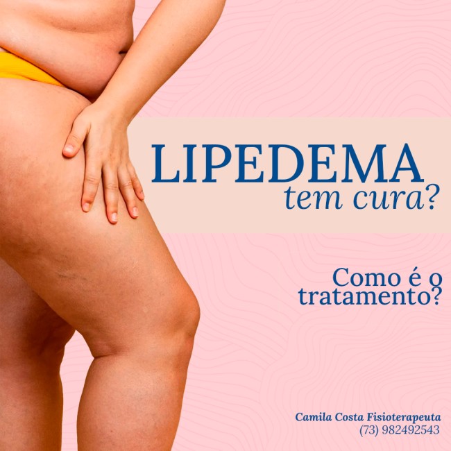 Lipedema tem cura? Como é o tratamento?