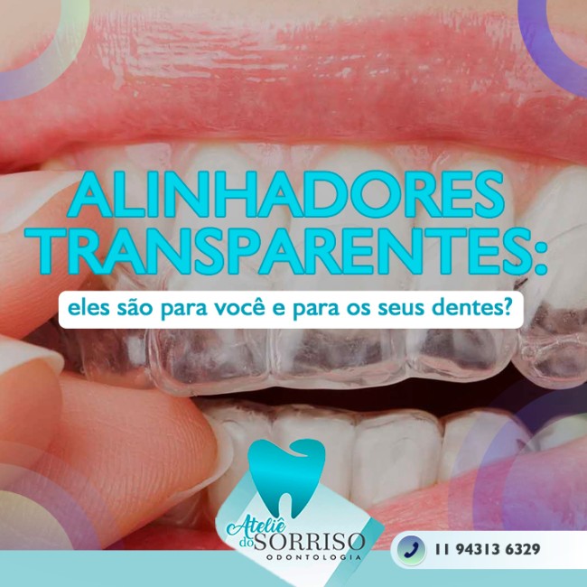 Alinhadores transparentes: eles são para você e para os seus dentes?