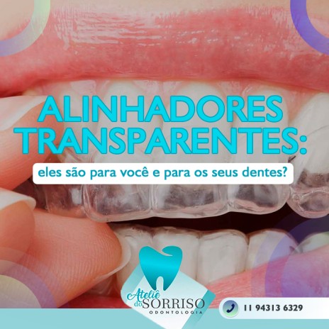 Alinhadores transparentes: eles são para você e para os seus dentes?