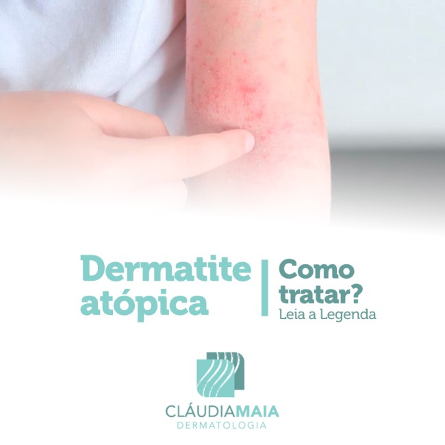 Dermatite atópica: como tratar?