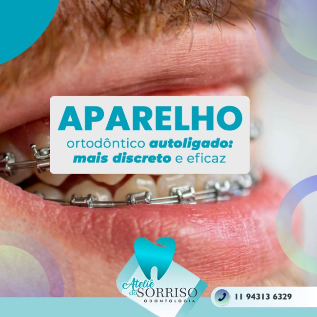 Aparelho ortodôntico autoligado: mais discreto e eficaz