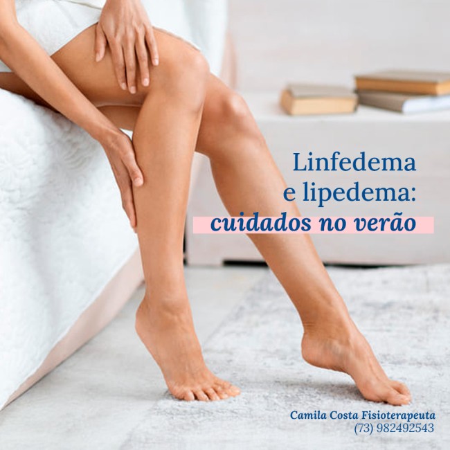 Linfedema e lipedema: cuidados no verão