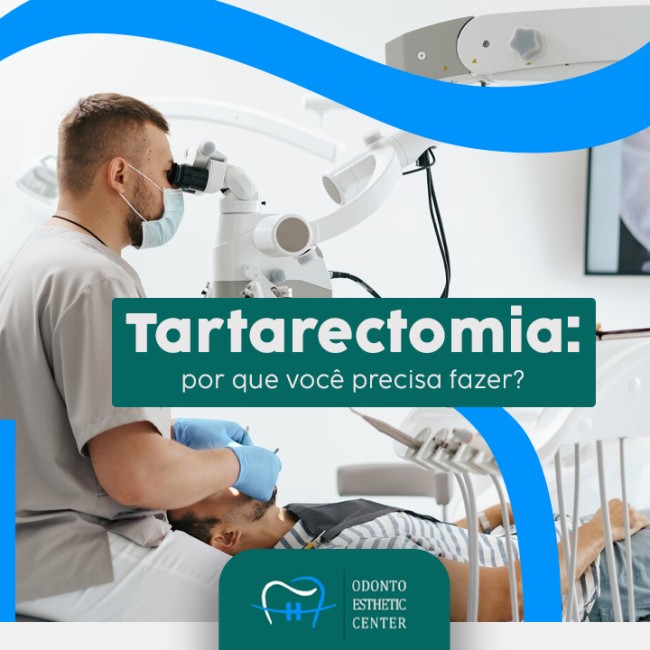 Tartarectomia: por que você precisa fazer