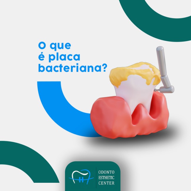 O que é placa bacteriana?