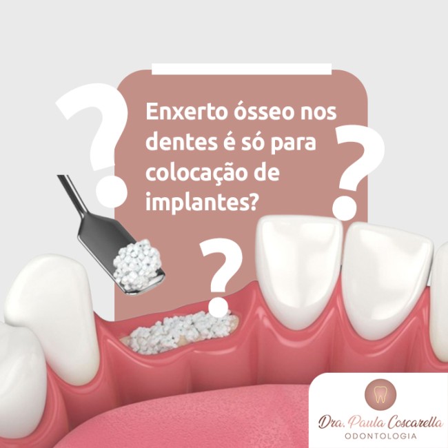 Enxerto ósseo nos dentes é só para colocação de implantes?