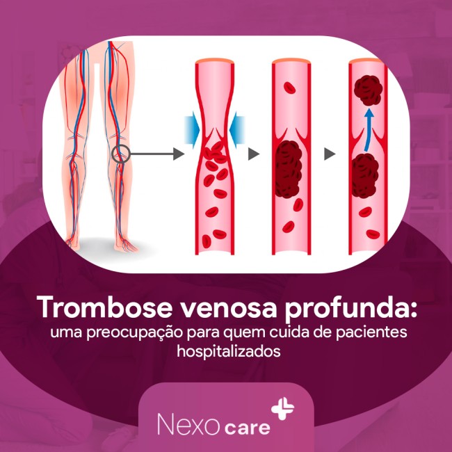 Trombose venosa profunda: uma preocupação para quem cuida de pacientes hospitalizados