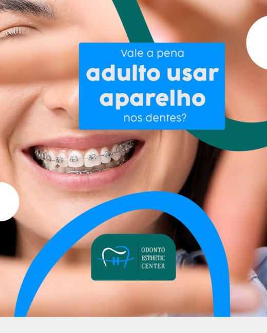 Vale a pena adulto usar aparelho nos dentes?