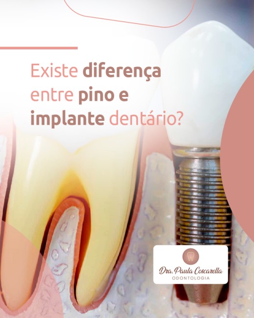 Existe diferença entre pino e implante dentário?