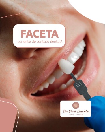 Faceta ou lente de contato dental?