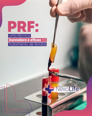 PRF: uma técnica inovadora e eficaz no tratamento de feridas