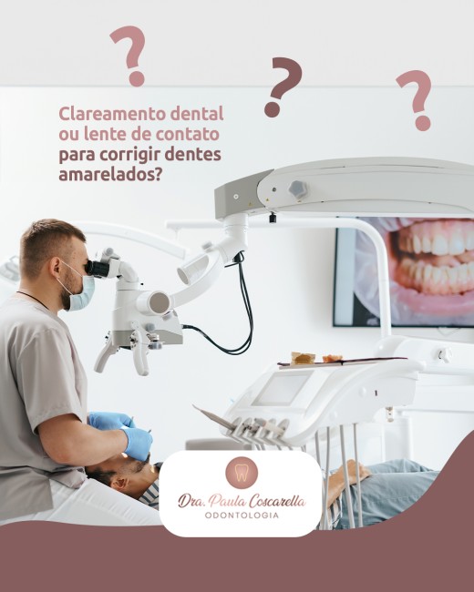 Clareamento dental ou lente de contato para corrigir dentes amarelados?