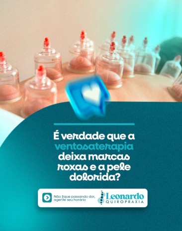 É verdade que a ventosaterapia deixa marcas roxas e a pele dolorida?
