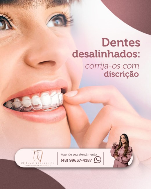 Dentes desalinhados: corrija-os com discrição