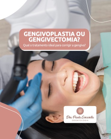 Gengivoplastia ou gengivectomia? Qual o tratamento ideal para corrigir a gengiva?