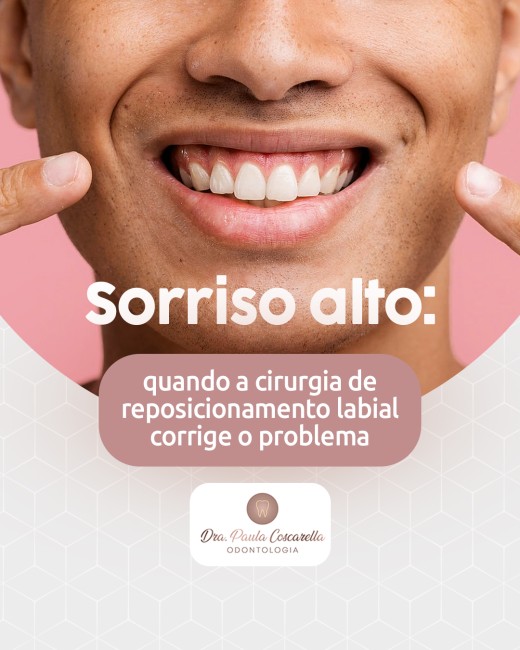 Sorriso alto: quando a cirurgia de reposicionamento labial corrige o problema