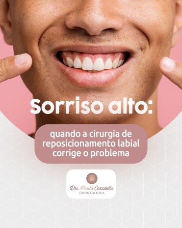 Sorriso alto: quando a cirurgia de reposicionamento labial corrige o problema