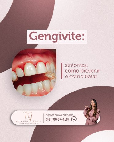 Gengivite: sintomas, como prevenir e como tratar