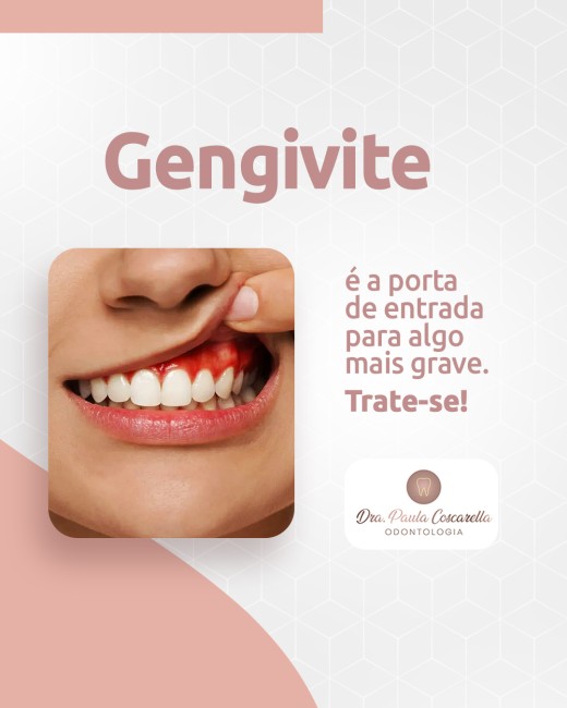 Gengivite é a porta de entrada para algo mais grave. Trate-se!