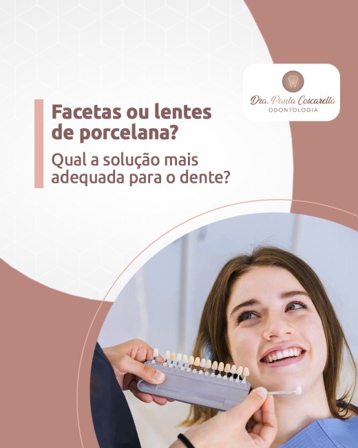 Facetas ou lentes de porcelana? Qual a solução mais adequada para o dente?