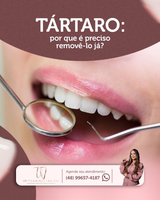 Tártaro: por que é preciso removê-lo já?