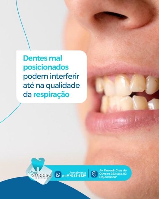 Dentes mal posicionados podem interferir até na qualidade da respiração