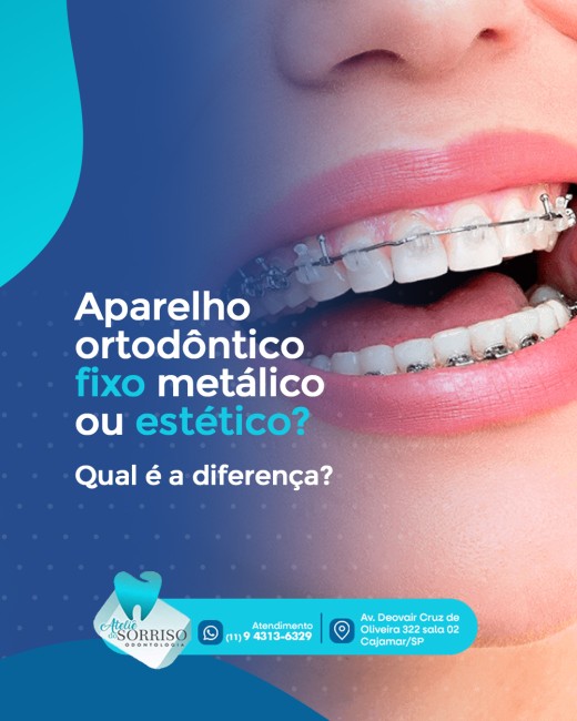 Aparelho ortodôntico fixo metálico ou estético? Qual é a diferença?