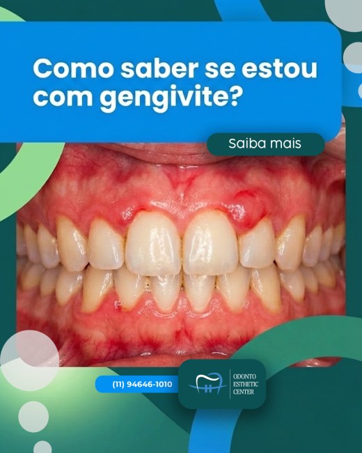 Como saber se estou com gengivite?